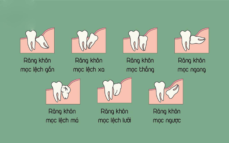 Những trường hợp răng khôn mọc kẹt
