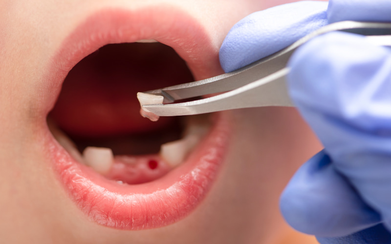 Nếu bé quá sợ hãi hoặc không hợp tác, hãy đưa bé đến nha sĩ để được nhổ răng an toàn.