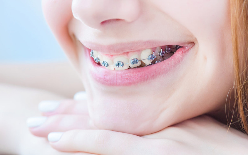 Niềng răng mắc cài cho trẻ em là loại mắc cài phổ biến nhất, có độ bền cao và chi phí thấp.
