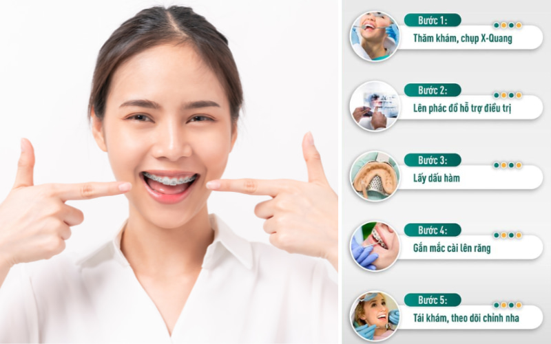 Quy trình niềng răng ở trẻ em