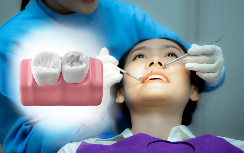 Trám răng được sử dụng để phục hồi răng bị tổn thương do sâu răng, mẻ vỡ hoặc các nguyên nhân khác.