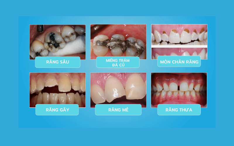 Các trường hợp trám răng 