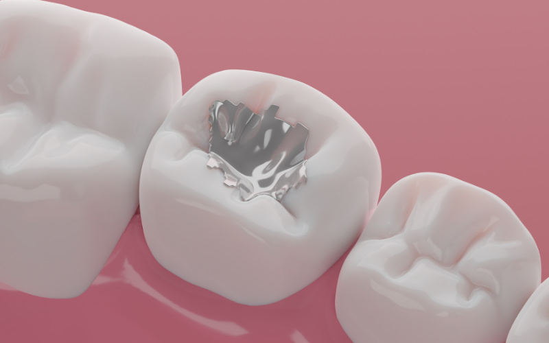 Amalgam là vật liệu trám răng màu bạc, được tạo từ hỗn hợp các kim loại như thủy ngân, bạc, thiếc và đồng.