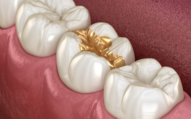 Trám răng mạ vàng sử dụng vật liệu từ hợp kim vàng, đồng và các kim loại khác như titan.