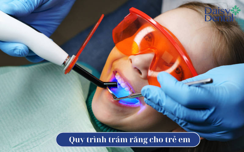 Trám răng ở trẻ em 5