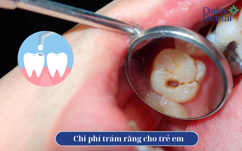 Trám răng ở trẻ em 6