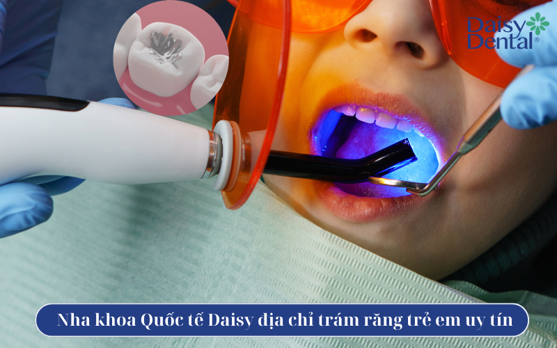 Trám răng ở trẻ em 8