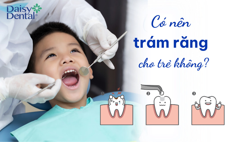 Trám răng cho trẻ là cần thiết trong nhiều trường hợp. Hãy tham khảo ý kiến của nha sĩ để đưa ra quyết định tốt nhất cho con bạn.