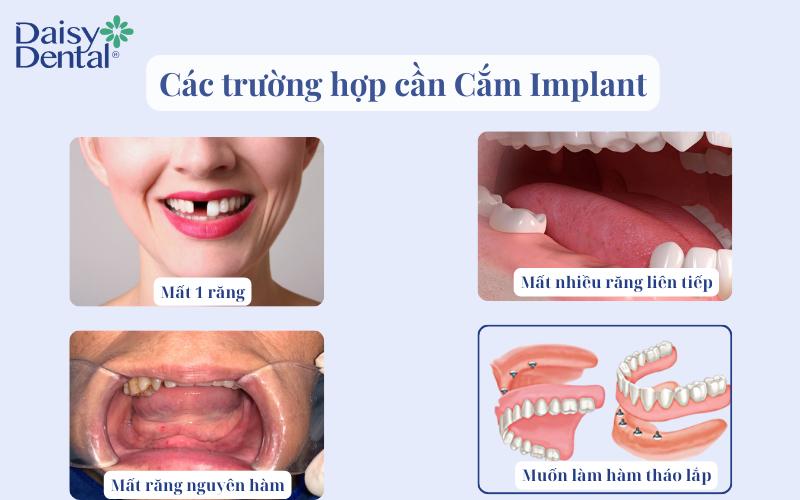 Trồng răng implant 10