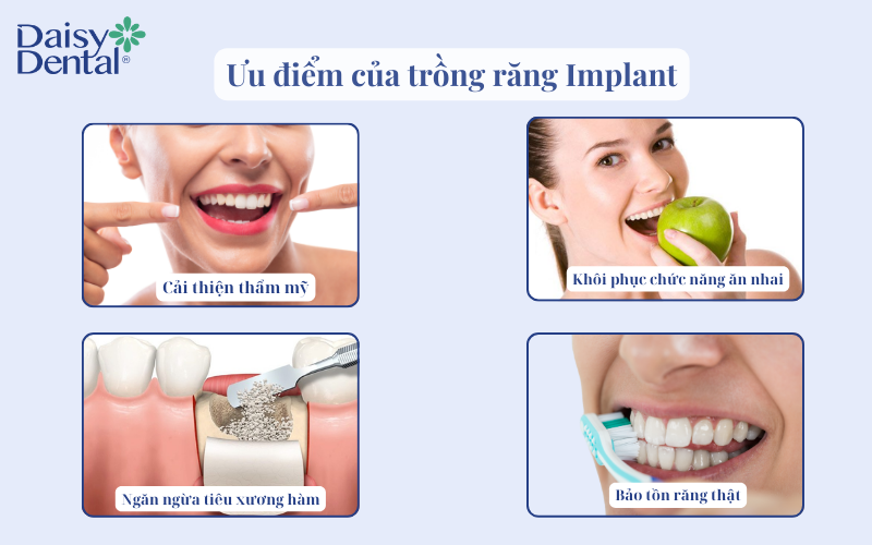 Trồng răng implant 11