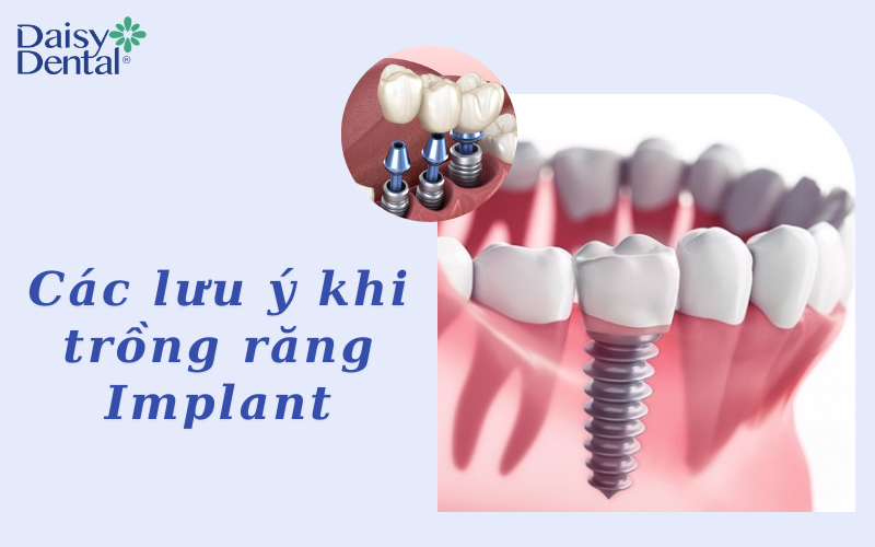 Trồng răng implant 12