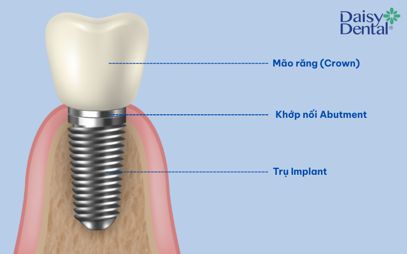Răng Implant có cấu tạo gồm 3 phần chính, mô phỏng gần giống như một chiếc răng thật
