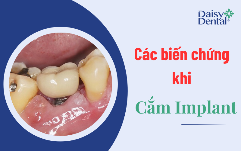 Trồng răng implant 9
