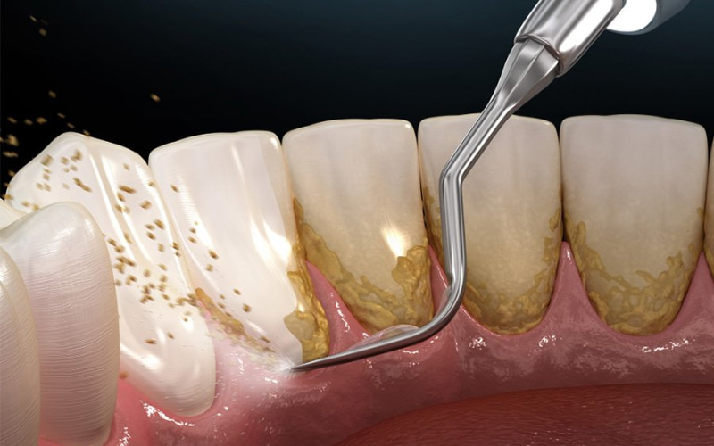 Cao răng lâu năm thường có màu vàng sẫm, có độ dày vượt quá 2mm. 