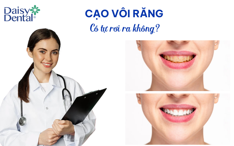 Cao răng thường không tự rơi ra, chỉ có thể được loại bỏ bằng các dụng cụ chuyên dụng tại phòng khám nha khoa thông qua quá trình cạo vôi răng.