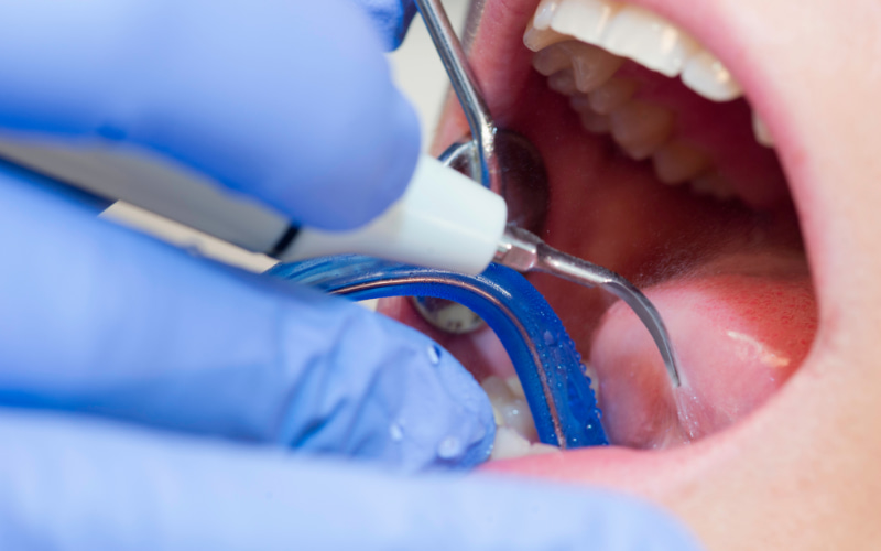 Bạn nên đi lấy cao răng định kỳ 3-6 tháng một lần, ngay cả khi bạn chưa nhận thấy có cao răng.