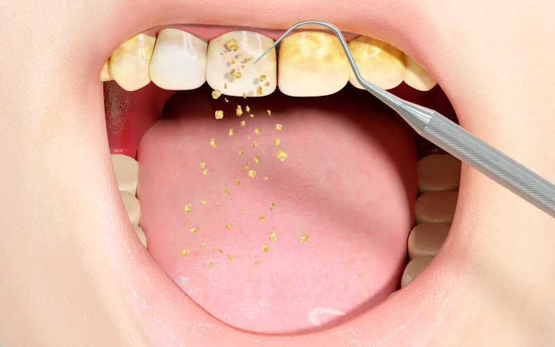 Cao răng tự vỡ thường không nguy hiểm và thậm chí có thể mang lại một số lợi ích cho sức khỏe răng miệng. 