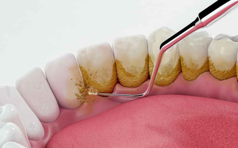 Lấy cao răng là một thủ thuật nha khoa quan trọng và cần thiết để duy trì sức khỏe răng miệng tốt, ngăn ngừa các bệnh lý răng miệng.