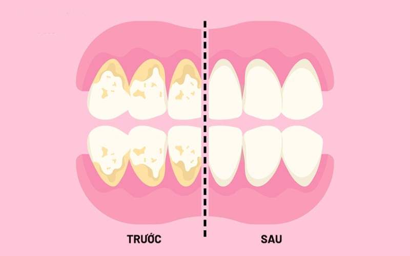 Cạo vôi và đánh bóng răng là một phần quan trọng trong việc chăm sóc sức khỏe răng miệng.