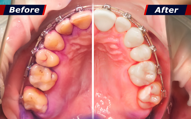 lấy cao răng bằng sóng siêu âm là một phương pháp hiện đại, an toàn và hiệu quả