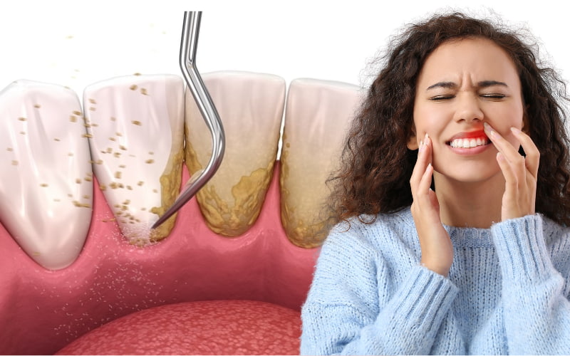 Cạo vôi răng là một bước quan trọng trong điều trị viêm nướu, đặc biệt khi nguyên nhân gây viêm là do mảng bám và vôi răng tích tụ.