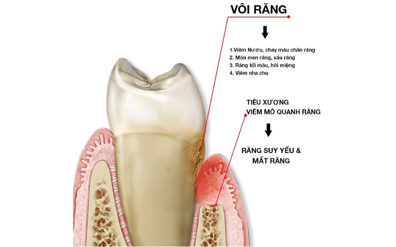 Cao răng là nguyên nhân chính dẫn đến các bệnh lý răng miệng nghiêm trọng như viêm nướu, viêm nha chu, sâu răng,...