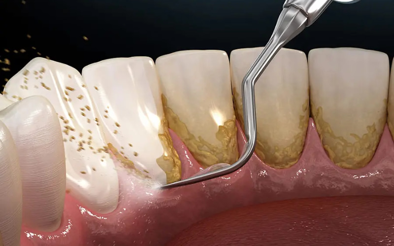 Cao răng không chỉ gây mất thẩm mỹ, các vấn đề răng miệng mà còn có thể ảnh hưởng tiêu cực đến sức khỏe tổng thể