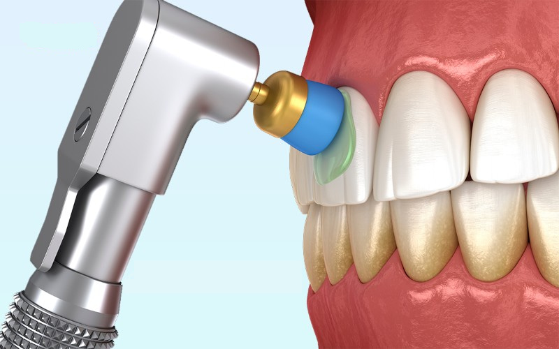 Đánh bóng răng là một thủ thuật thường được thực hiện ở cuối buổi làm sạch răng chuyên nghiệp (cạo vôi răng và mảng bám)