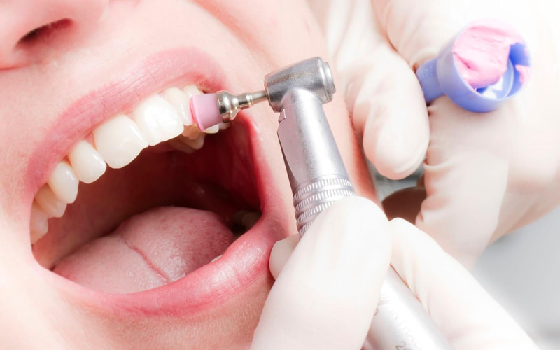 Đánh bóng răng không có tác dụng làm trắng răng, tuy nhiên có thể giúp làm sạch và làm mịn bề mặt răng hiệu quả. 