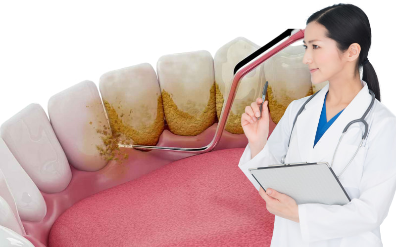 Lấy cao răng là quy trình nha khoa nhằm loại bỏ các mảng bám cứng (vôi răng, cao răng) đã tích tụ trên bề mặt răng và dưới đường viền nướu.