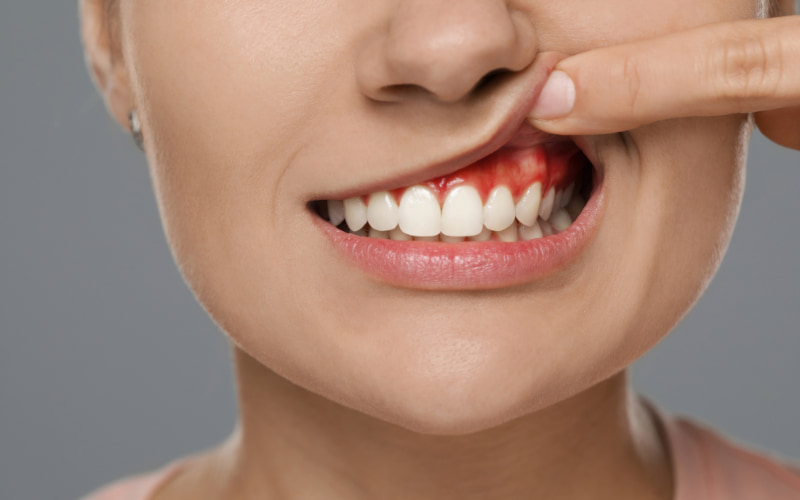 Quá trình lấy cao răng không cẩn thận có thể gây tổn thương nướu.