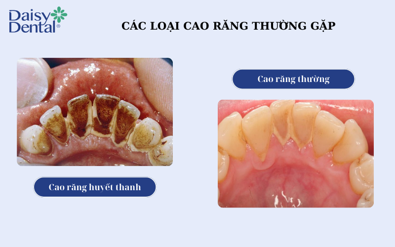 Lấy cao răng dưới nướu 1