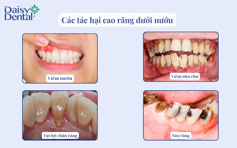 Lấy cao răng dưới nướu 2