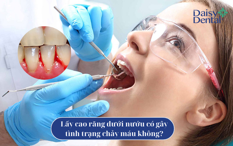 Lấy cao răng dưới nướu 4