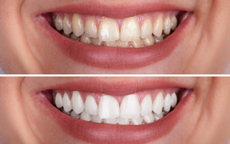 việc lấy cao răng định kỳ (thường 3-6 tháng một lần) là một biện pháp phòng ngừa và điều trị các bệnh về răng miệng hiệu quả,