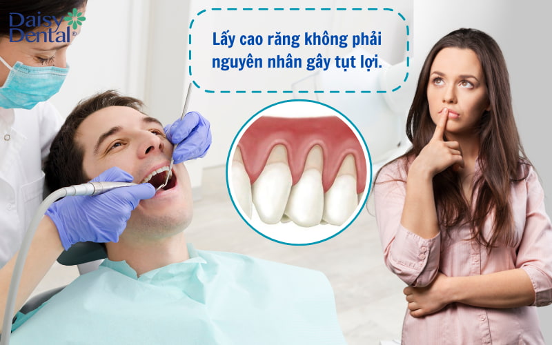 Lấy cao răng không gây ra tụt lợi.