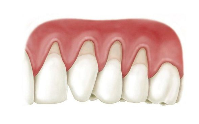 Mảng bám và cao răng tích tụ là môi trường lý tưởng cho vi khuẩn phát triển, gây viêm lợi và dẫn đến tụt lợi.