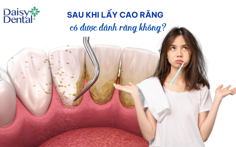  Theo các bác sĩ nha khoa, bạn nên đợi ít nhất 2 tiếng sau khi lấy cao răng rồi mới đánh răng.