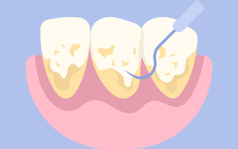 Cao răng (hay còn gọi là vôi răng) là mảng bám cứng đầu hình thành trên bề mặt răng, thường có màu vàng hoặc nâu.
