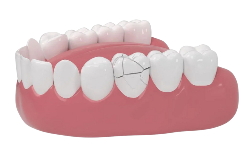 Các tác động vật lý như ăn đồ cứng, nghiến răng hoặc chấn thương là những nguyên nhân phổ biến khiến răng sứ bị mẻ, vỡ