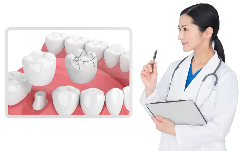 Răng sứ bị mẻ hay cầu răng sứ bị mẻ không thể thực hiện trám (hàn) để khôi phục lại răng sứ. 