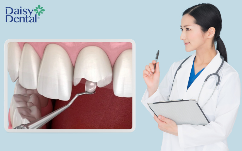 Đề xuất phương án điều trị phù hợp, có thể là trám bổ sung (nếu vết vỡ nhỏ) hoặc thay thế toàn bộ miếng trám cũ (nếu vết vỡ lớn).
