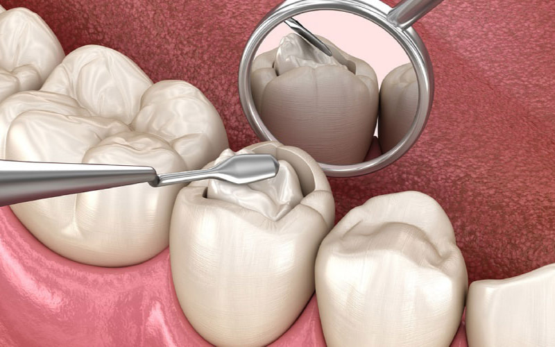 Trám răng là một kỹ thuật nha khoa phổ biến nhằm phục hồi những răng bị tổn thương do sâu răng, sứt mẻ, gãy vỡ hoặc mòn.