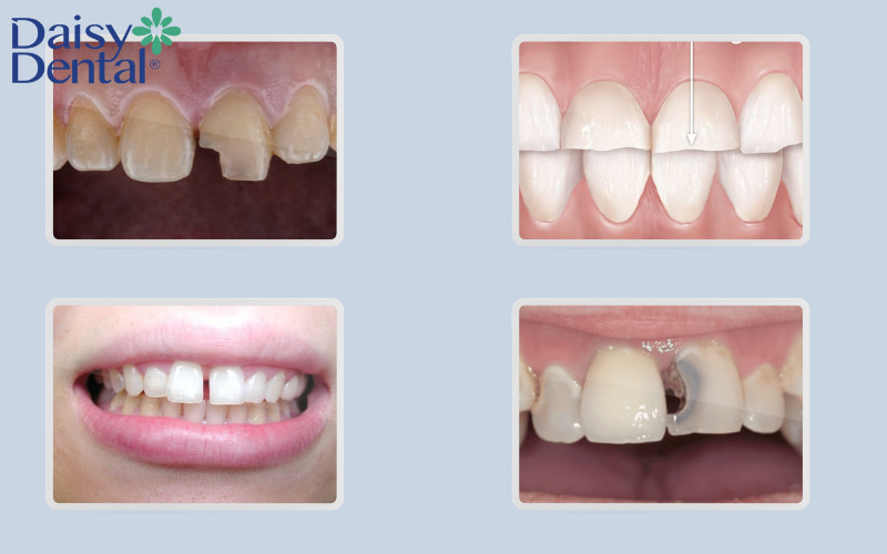 trám răng cửa là một giải pháp hiệu quả cho nhiều vấn đề thẩm mỹ và chức năng liên quan đến răng cửa ở mức độ nhẹ đến trung bình.