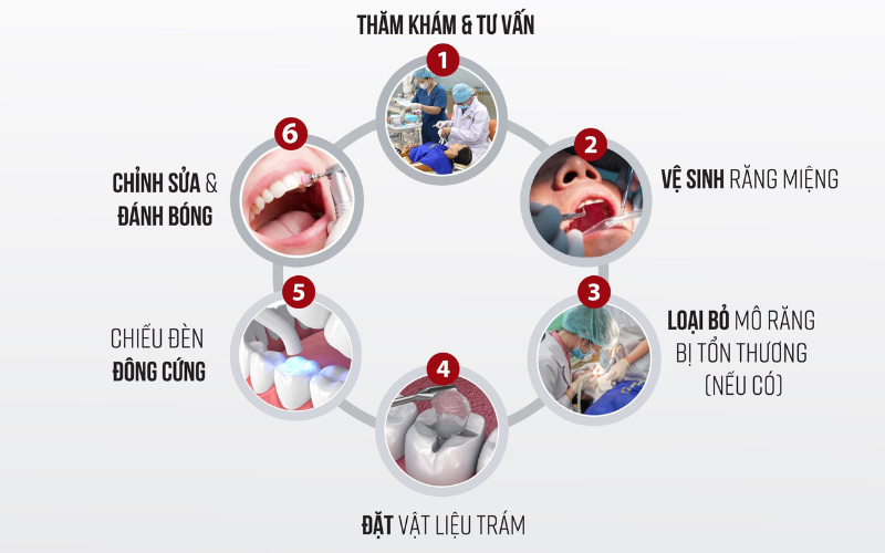 Quy trình trám răng cửa tại Nha khoa