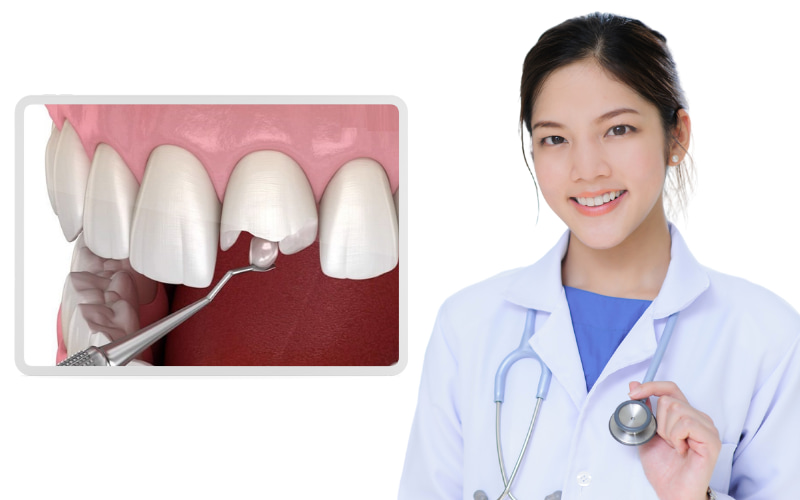 So với các phương pháp phục hình khác như bọc răng sứ, trám răng cửa thường có độ bền thấp hơn.