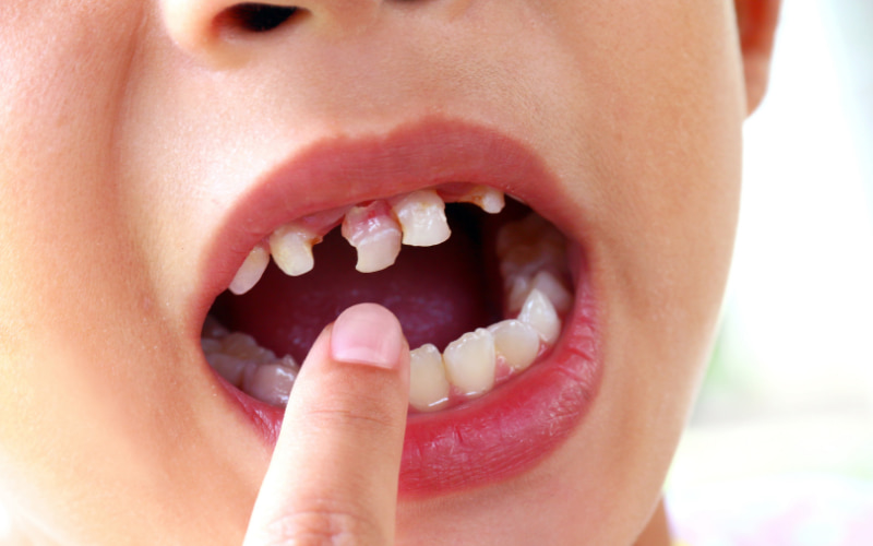 Sâu răng cửa xảy ra do nhiều yếu tố kết hợp lại, trong đó nguyên nhân chính là do vi khuẩn trong miệng tạo ra axit ăn mòn men răng.