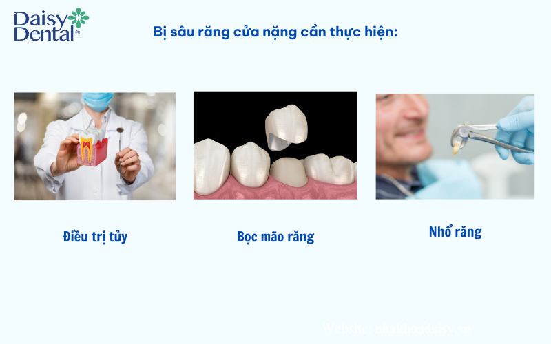 Bị sâu răng cửa nặng phải làm sao?