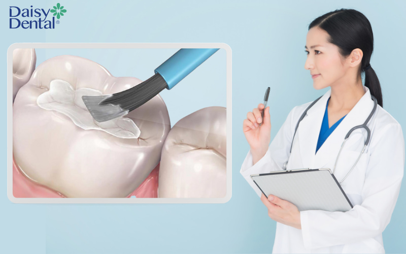 GIC (Glass Ionomer Cement) - Một loại vật liệu trám răng được hình thành bởi axit acrylic và bột thủy tinh mịn