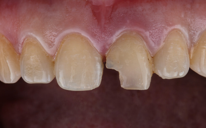 Răng mẻ do chấn thương có thể thực hiện trám răng GIC.